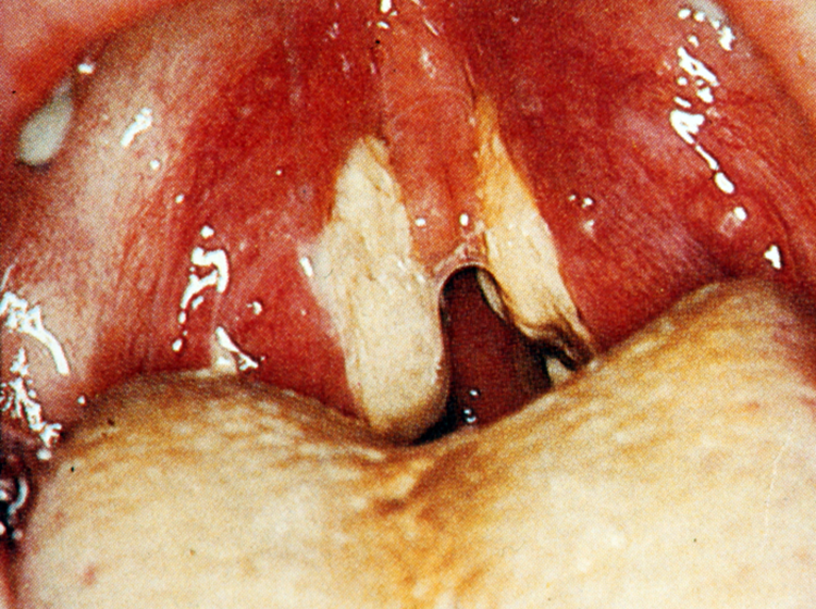 Uvula Swollen After Tonsillectomy uvula-swollen-after-tonsillectomy