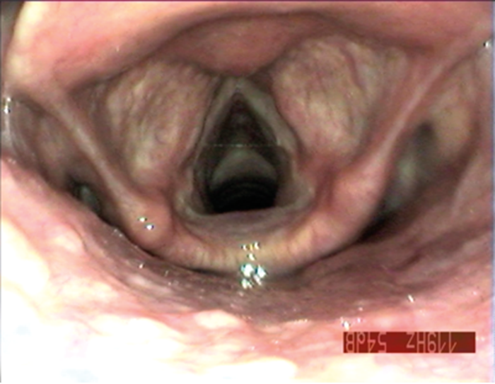 laryngeal papillomatosis onset