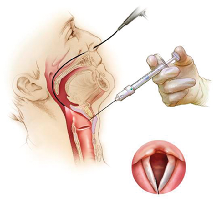 Vocal cord paralysis an update ENT & Audiology News
