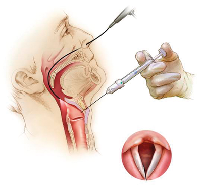 Vocal cord paralysis: an update  ENT & Audiology News