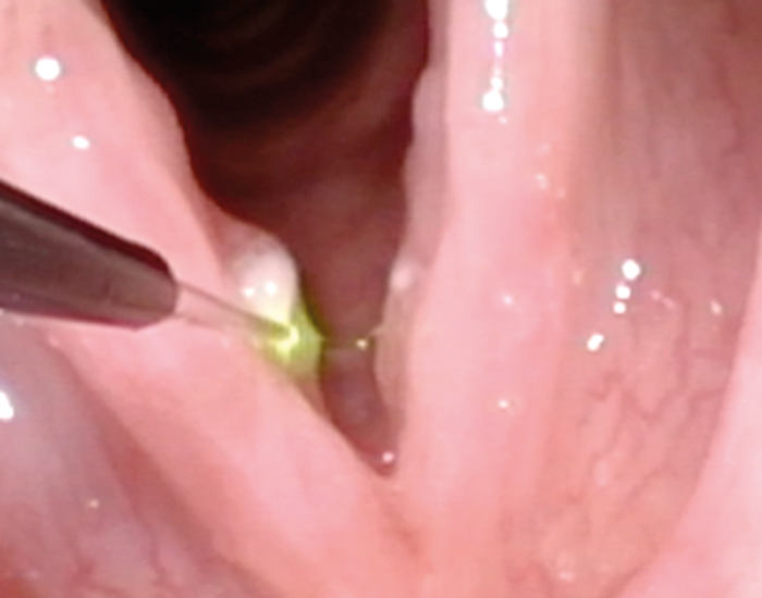 Laryngeal papillomatosis treatment