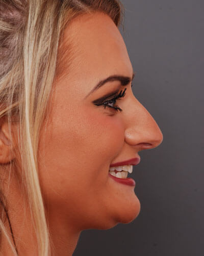 side view of patient's nose