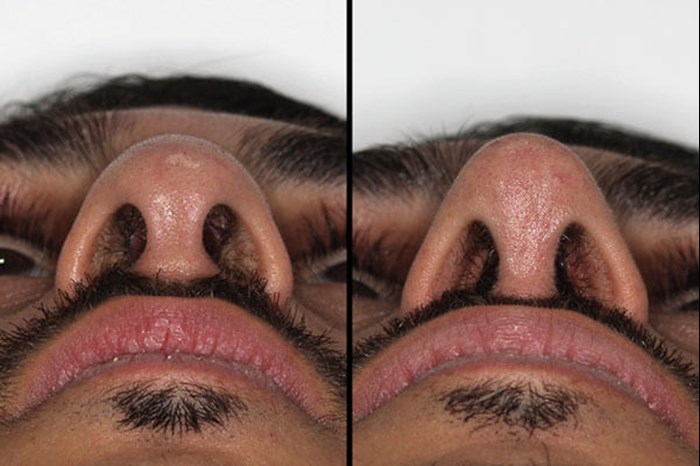 The Tip In Rhinoplasty Ent Audiology News