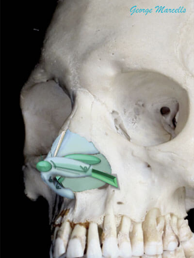 Underlay lateral crural strut graft (dark green, with contour grafts)