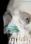 Underlay lateral crural strut graft (dark green, with contour grafts)