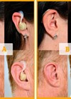 An example of a direct-to-consumer device (left panel) and NHS hearing aid (right panel) modelled by male and female wearers