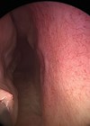 Microdebrider in submucosal plane