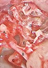 Left ear transcanal endoscopic view photo