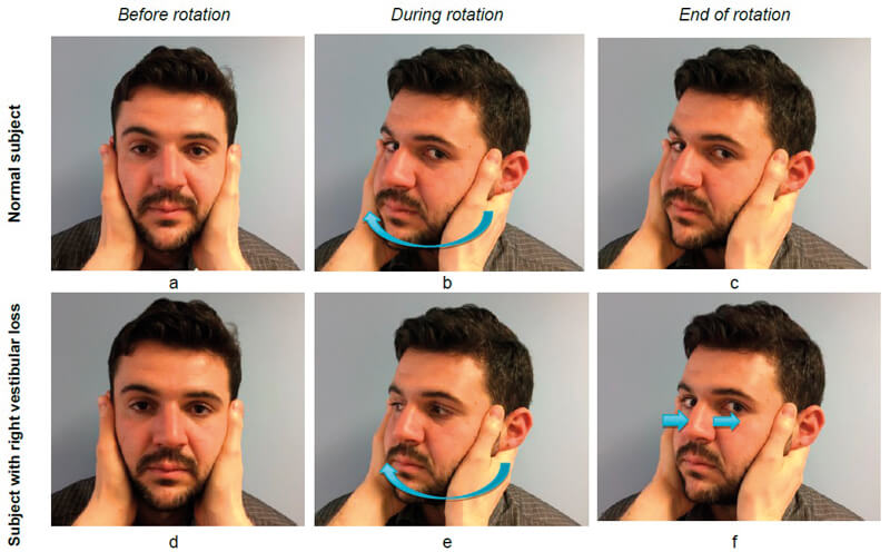 Developments In Diagnostic Approaches For Acutely Dizzy Patients Ent Audiology News