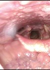 White light flexible nasendoscopy of the base of tongue photo