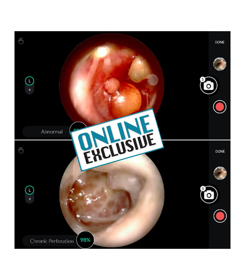 HearScope app displaying abnormal otoscopy results, classified, and with confidence level.
