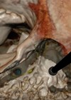 Photo showing the virtual reality simulator CardinalSimdepicting a left mastoidectomy and facial recess approach.