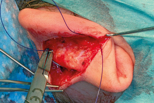 Placing the suture between the mid-helix and the mastoid fascia photo