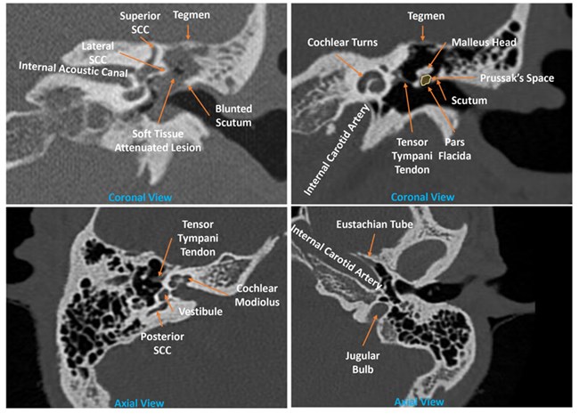 SCOTLAND preoperative tympanomastoid CT temporal bone mnemonic system