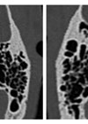 Scans showing facial nerve anatomy in the temporal bone.