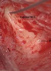 Photo showing all three semi-circular canals identified (right ear).