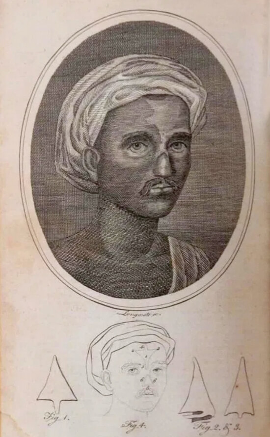 Photo showing an article in The Gentleman’s Magazine in 1794 described the operation of making  a nose from a forehead flap, accompanied by an engraving of the patient with the restored nose