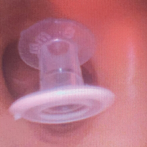 Photo showing endoscopic view of an aspirated Blom-Singer® ClassicTM indwelling voice prosthesis (InHealth Technologies, Carpinteria, CA, USA) within the right main bronchus.
