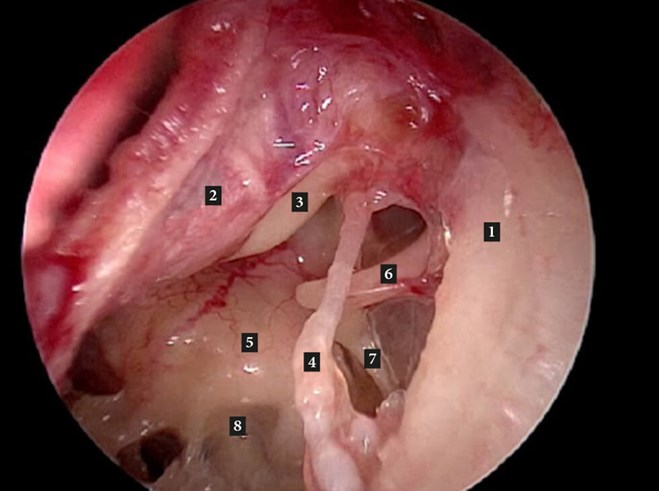 Stapes Surgery