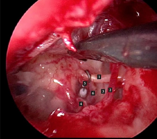 Stapes Surgery
