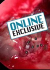 Endoscopic stapes surgery article Online Exclusive image.