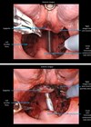 Photos showing intraoperative view of the oropharynx.