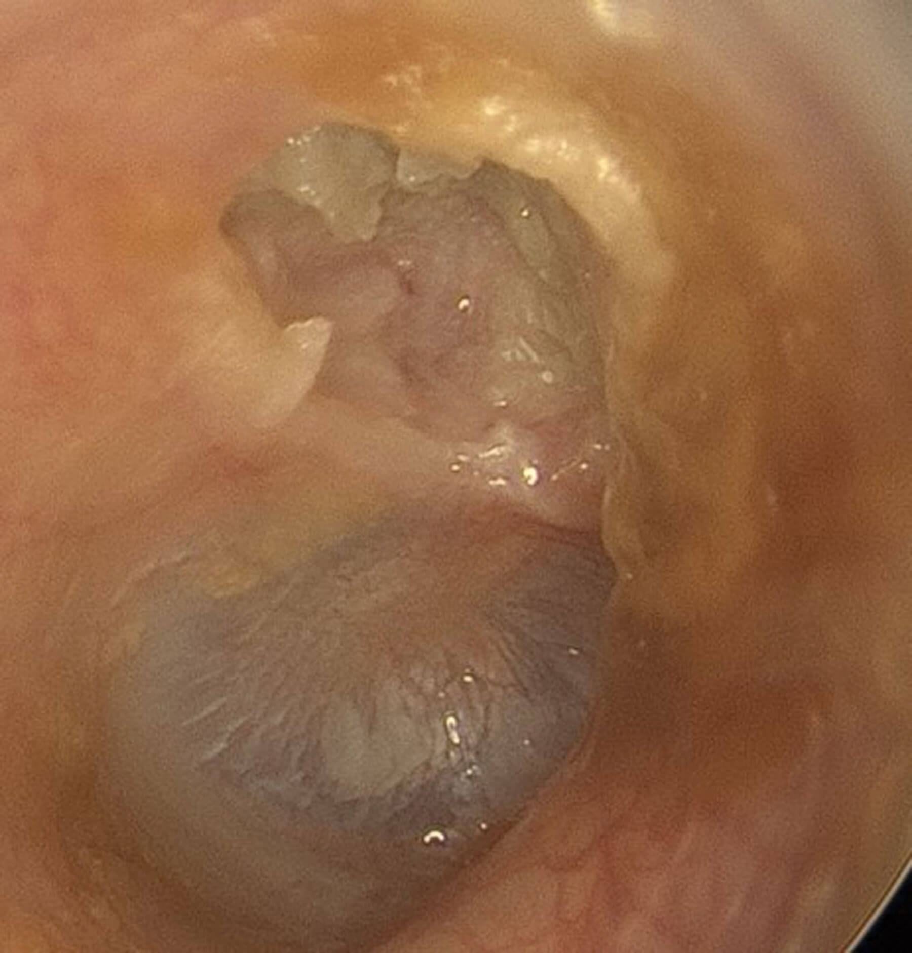 Photo of right attic cholesteatoma.