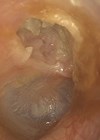 Photo of right attic cholesteatoma.