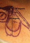 Photo showing dimensions of the first lobe are approximately equal to that of the defect, whereas the second lobe may need to be up to twice as long, though half as wide.