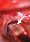 Photo showing mastoidectomy performed on the left ear.