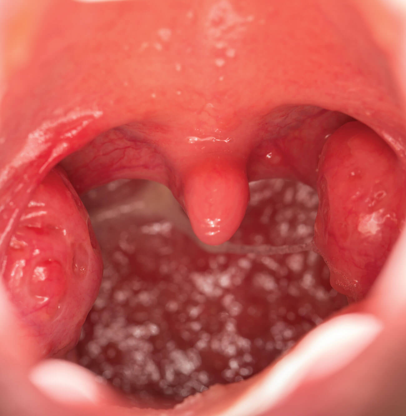 Photo showing tonsils.