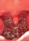 Photo showing tonsils.