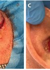 Photos showing external ear reconstruction.