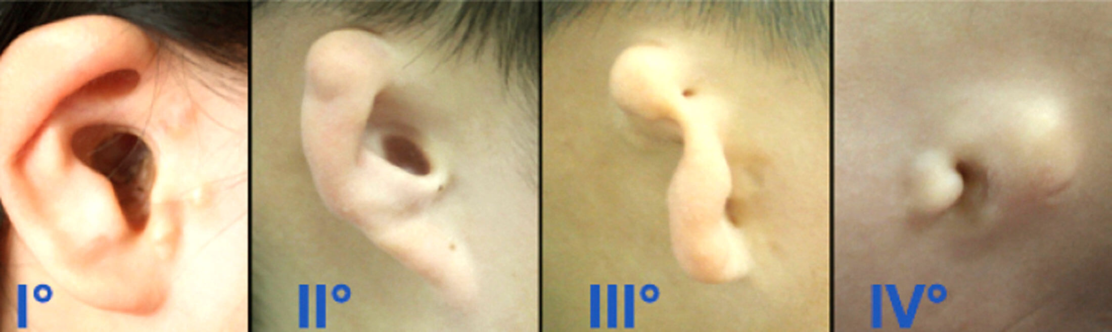 Images showing classification of microtia. 
