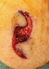 The flap lobes and their apposing surfaces are undermined deeply to provide adequate closure - photo image.