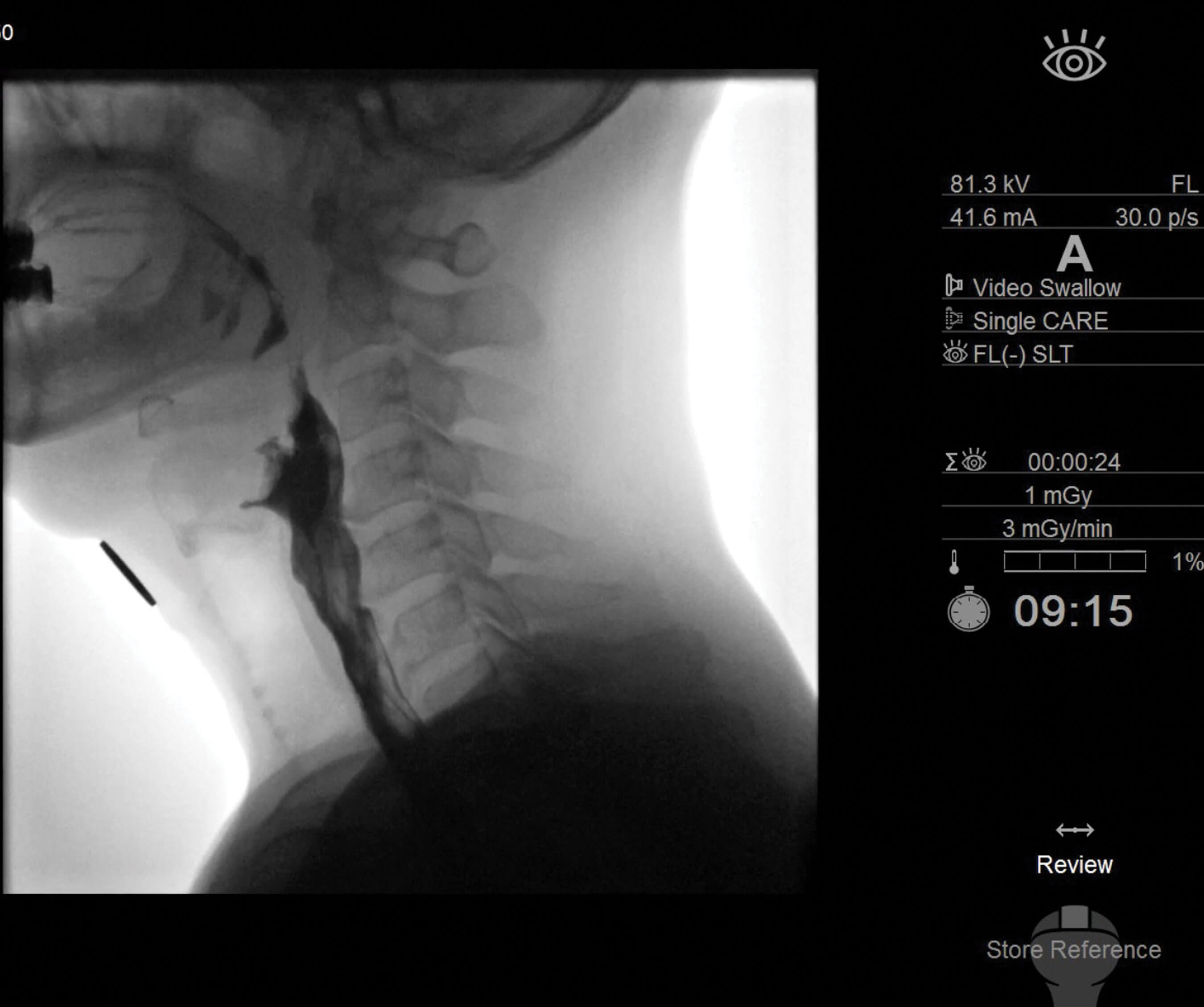 Lateral image during fluoroscopic swallowing study, mid swallow, centred on the pharynx.