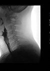 Lateral image during fluoroscopic swallowing study, mid swallow, centred on the pharynx.