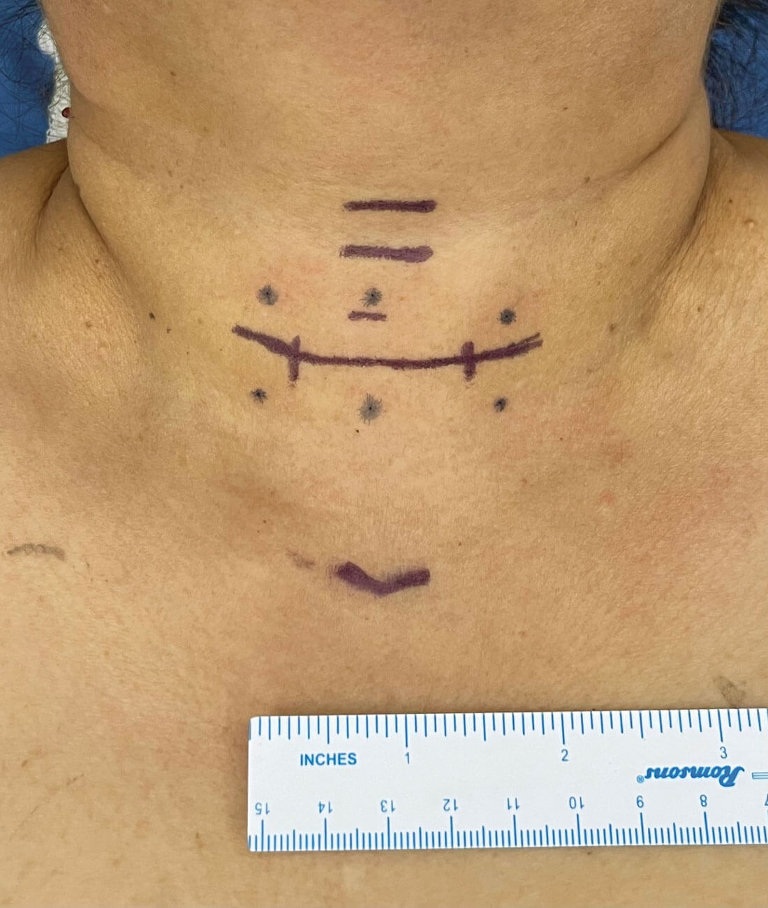 Photos showing how thyroid and parathyroid surgery can be performed through very small aesthetic incisions on the neck.