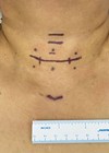 Photos showing how thyroid and parathyroid surgery can be performed through very small aesthetic incisions on the neck.