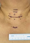 Photos showing how thyroid and parathyroid surgery can be performed through very small aesthetic incisions on the neck. 