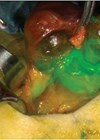 Image showing Intraoperative injection of ICG to identify feeding vessel to aid with preservation.