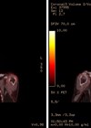 Graphic showing PET/CT coronal images of patient.