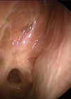 Scan showing scarred olfactory cleft following middle turbinate section.