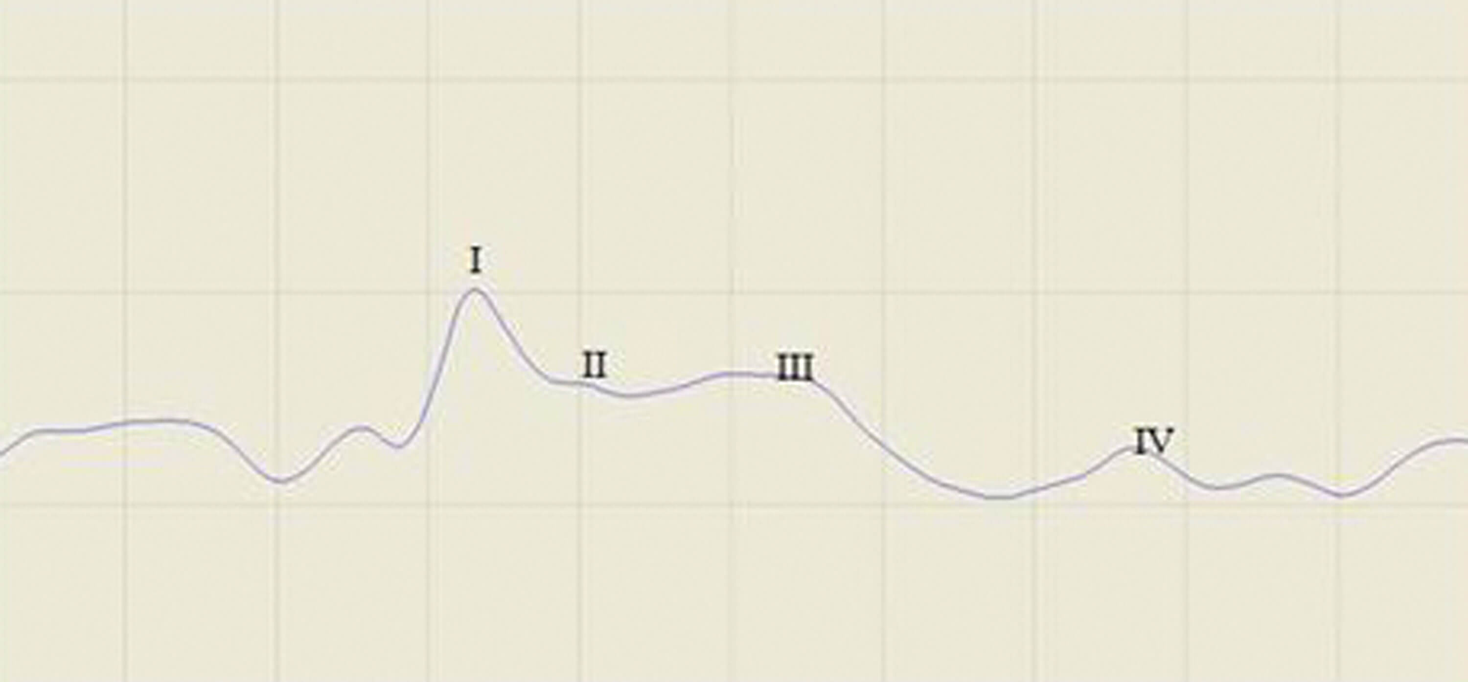 Graph showing eABR wave form with four peaks. 