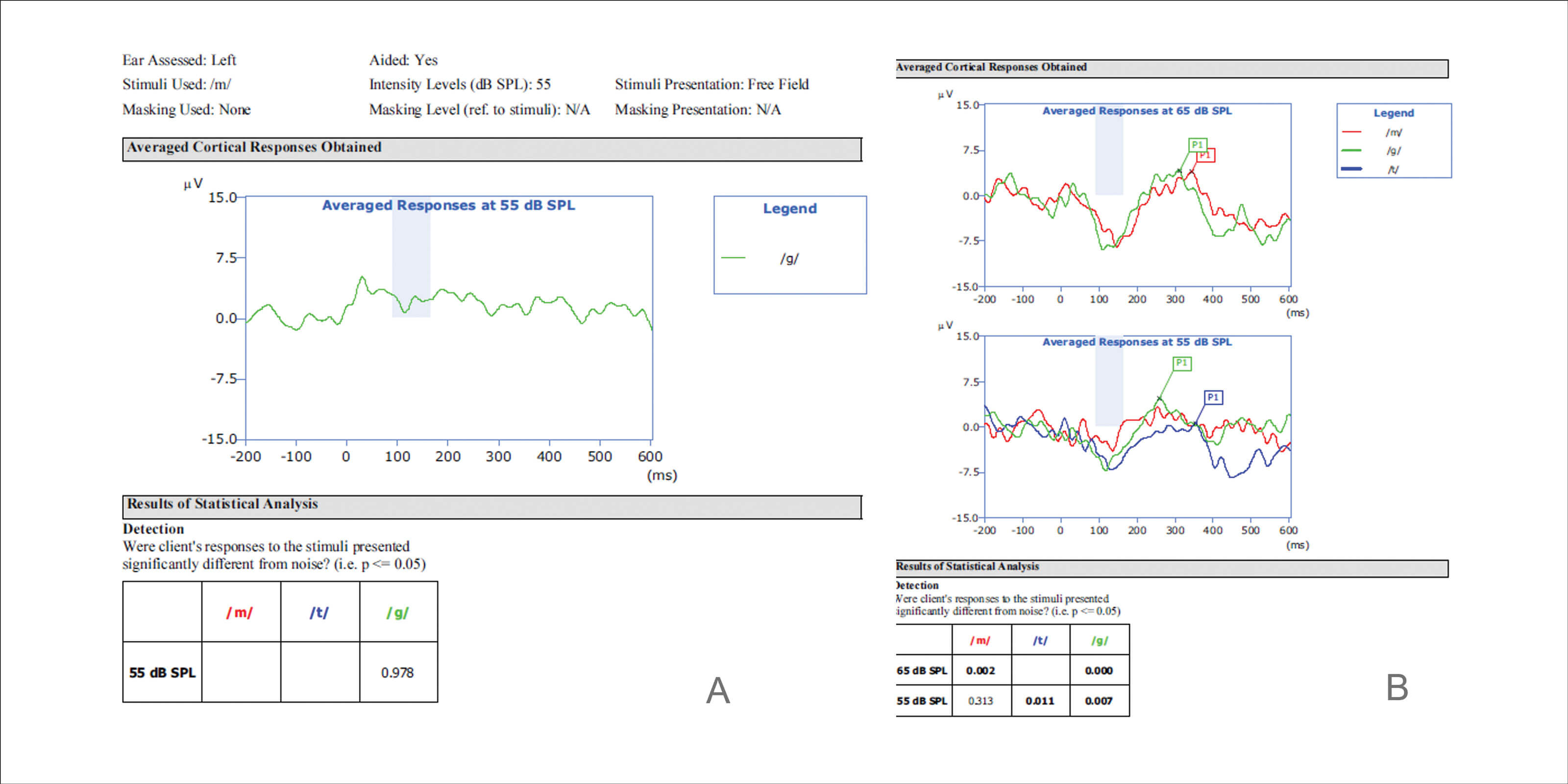 Graphs showing ANO: A. Preliminary programme, no P1 response to /G/ at 55 dB SPL. B. Modified programme, late latency P1 response to /M/ and /G/ at 55 dB SPL and /T/ at 65 dB SPL.