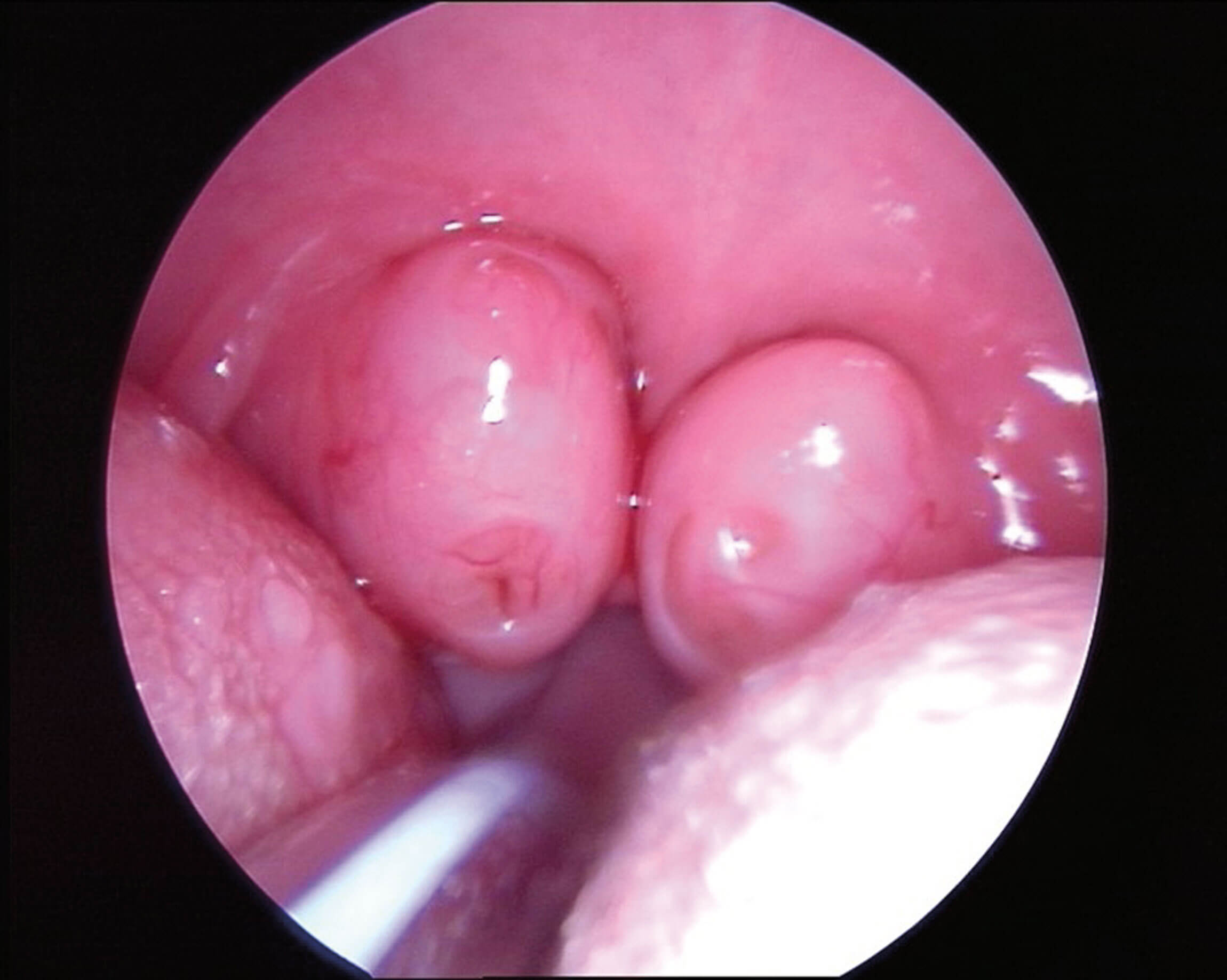 Scan showing tonsillar hypertrophy 