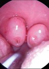 Scan showing tonsillar hypertrophy 