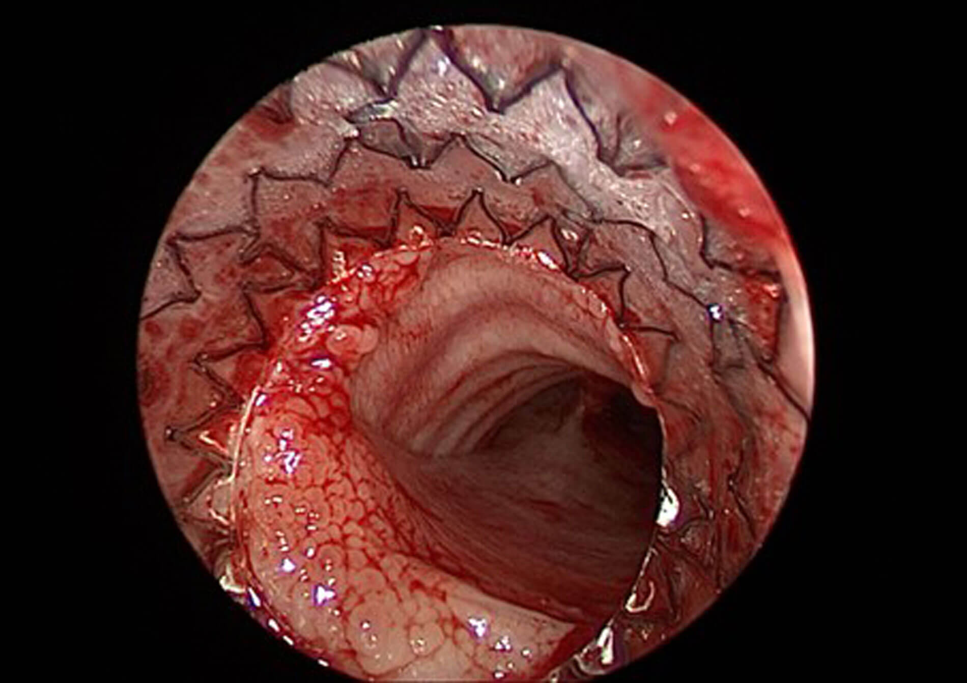 Endoscopic view of airway following AERO-stent deployment for severe malacia. 