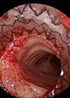 Endoscopic view of airway following AERO-stent deployment for severe malacia. 