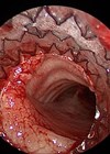 Endoscopic view of airway following AERO-stent deployment for severe malacia.